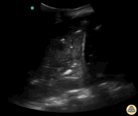 Bronchogramme aerique