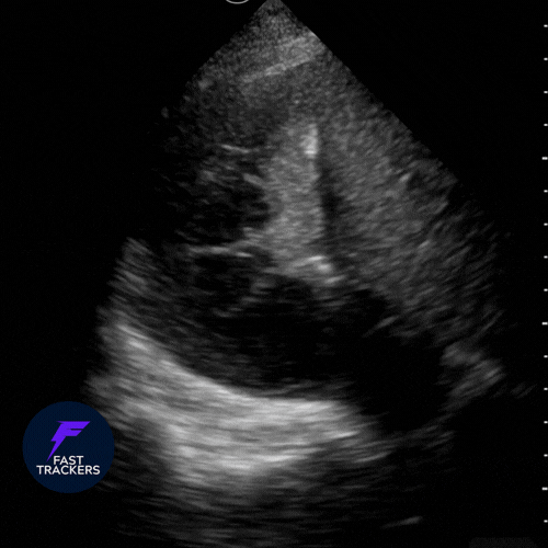 signe de la méduse, épanchement pleural
