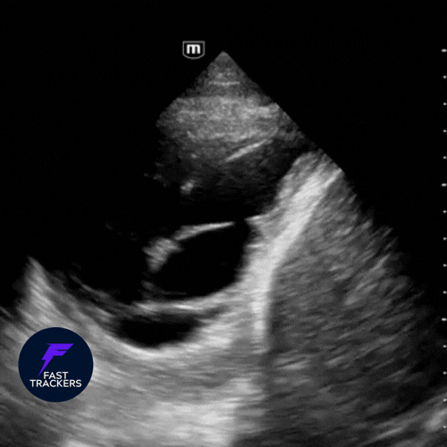 empyème pleural, epanchement cloisonné