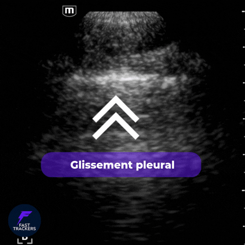isualisation du glissement pleural (Pleural Sliding) et des lignes A.