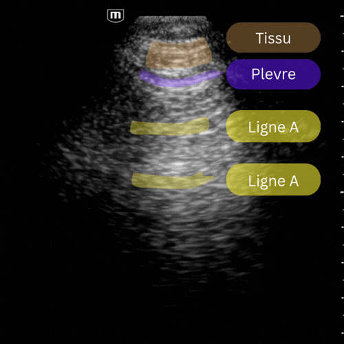 GIF Semiologie normale pulmonaire a l échographie, avec glissement pleural, lignes a