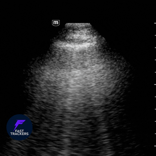 Échographie pulmonaire pathologique : syndrome interstitiel avec lignes B multiples et coalescentes.