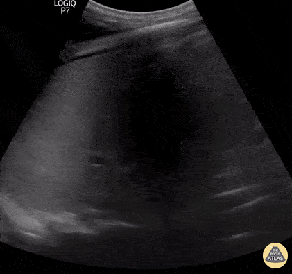 Consolidation pulmonaire
