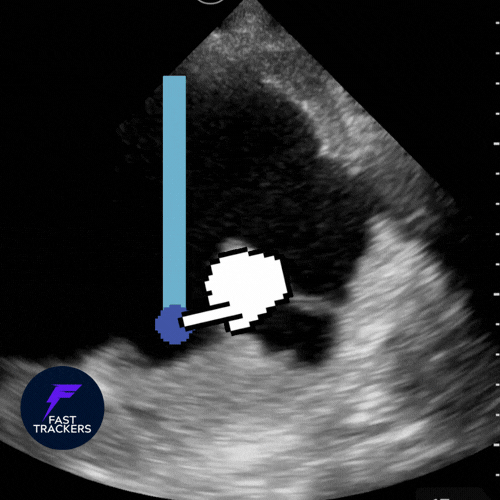 Mesure de l'épaisseur d'un épanchement pleural en échographie : distance inter-pleurale.
