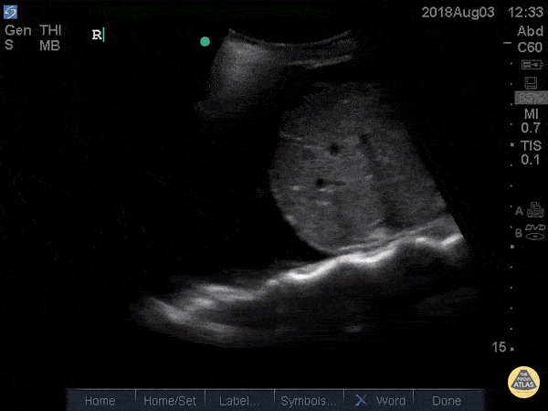 Signe de la colonne vertébrale