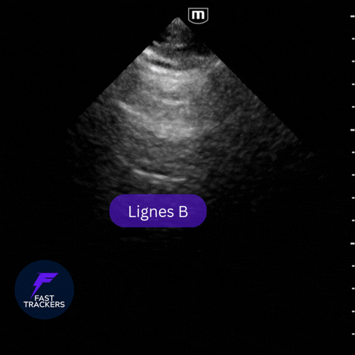 Échographie pulmonaire montrant des lignes B physiologiques isolées et un glissement pleural normal.